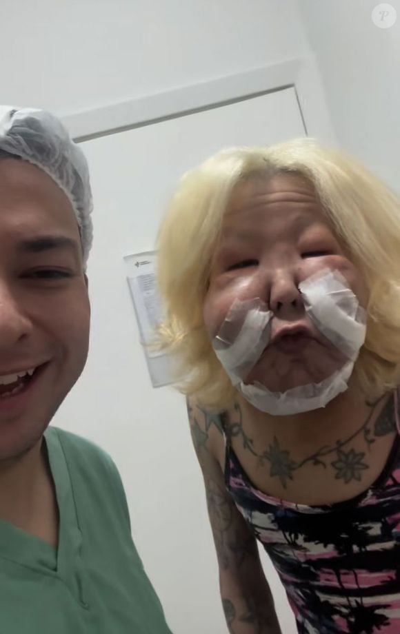 No último dia 20 de novembro, Juju do Pix passou por uma cirurgia reparadora para a remoção do óleo mineral do rosto