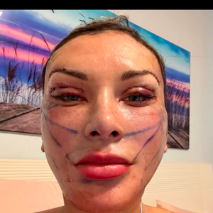 Neste sábado (09), Andressa Urach exibiu para seus seguidores como estava seu rosto apenas um dia após a cirurgia