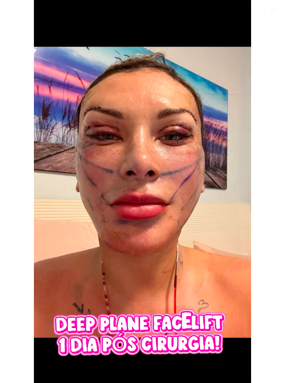Neste sábado (09), Andressa Urach exibiu para seus seguidores como estava seu rosto apenas um dia após a cirurgia