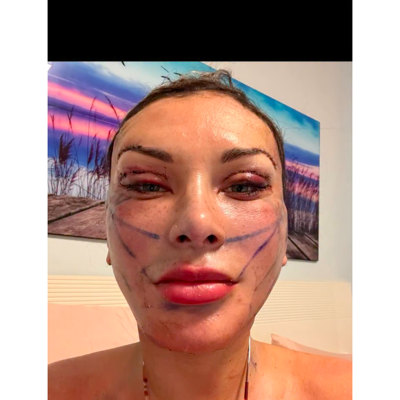 Neste sábado (09), Andressa Urach exibiu para seus seguidores como estava seu rosto apenas um dia após a cirurgia