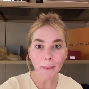 Procedimento estético de Virgínia Fonseca vira assunto nas redes após influenciadora aparecer com rosto sensível e avermelhado