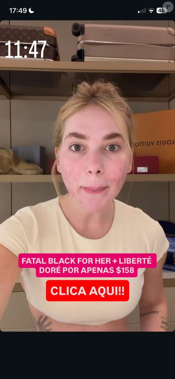 Procedimento estético de Virgínia Fonseca vira assunto nas redes após influenciadora aparecer com rosto sensível e avermelhado