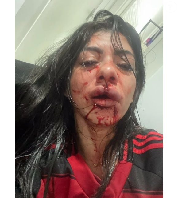 Namorada do cantor Dieguin Damasceno exibiu rosto ferido após agressões do músico