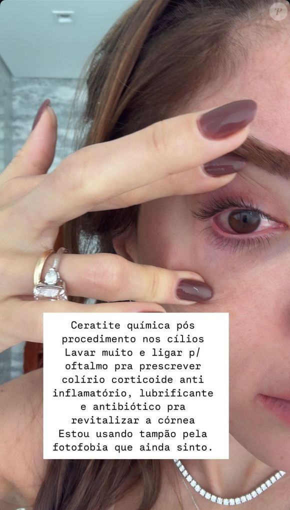 Romana Novais recebeu o diagnóstico de Ceratite Química, após o procedimento nos cílios; além disso, deu uma importante orientação aos seguidores, principalmente para o público feminino.
