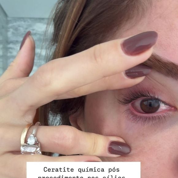 Romana Novais recebeu o diagnóstico de Ceratite Química, após o procedimento nos cílios; além disso, deu uma importante orientação aos seguidores, principalmente para o público feminino.