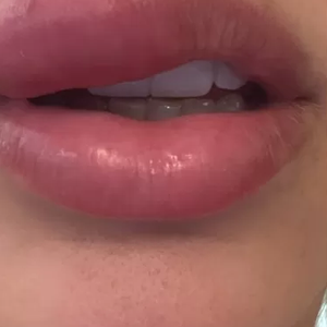 ‘Quando a pessoa espreme uma espinha, por exemplo, cria-se um ponto de entrada para bactérias na pele, o que pode desencadear a infecção’, explica especialista