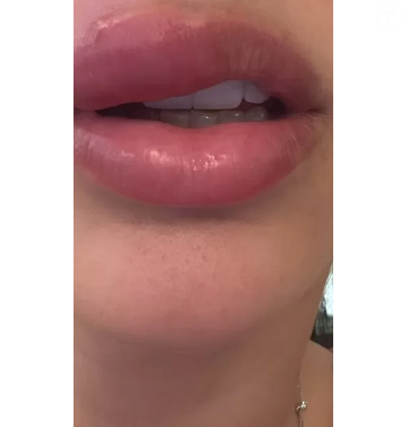 ‘Quando a pessoa espreme uma espinha, por exemplo, cria-se um ponto de entrada para bactérias na pele, o que pode desencadear a infecção’, explica especialista