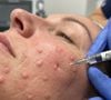 O PDRN, conhecido popularmente como "esperma de salmão", ganhou espaço na cosmética coreana após anos de uso na medicina regenerativa, especialmente em processos de cicatrização e reparação dos tecidos. O ingrediente é formado por fragmentos de DNA altamente purificados e tem potencial para favorecer a regeneração celular, modular a inflamação e melhorar a qualidade da pele