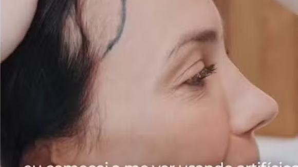 Com alopecia androgenética, Juliana Knust faz transplante capilar sem raspar cabelo; tricologista revela tratamentos que ajudam a recuperar os fios