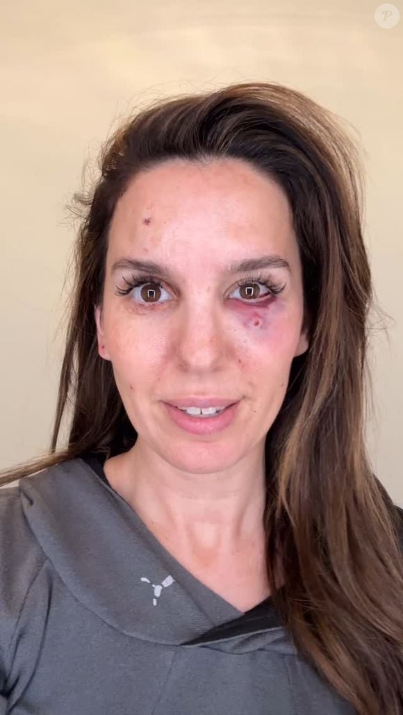 Christy Carlson Romano voltou a falar do susto que passou em fevereiro deste ano, quando foi baleada no rosto com balas de chumbo fino durante a festa de aniversário do marido