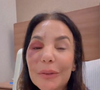 Cantora Ivete Sangalo mostra inchaço no rosto após procedimento cirúrgico para tratar fratura causada por desmaio em casa