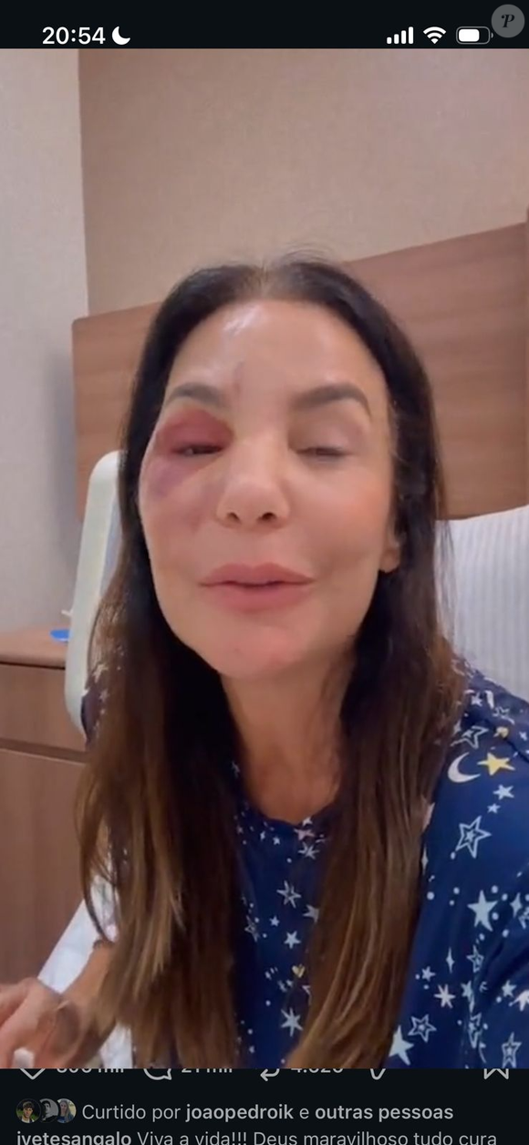 Cantora Ivete Sangalo mostra inchaço no rosto após procedimento cirúrgico para tratar fratura causada por desmaio em casa