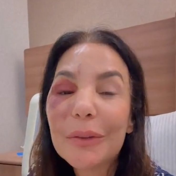 Cantora Ivete Sangalo mostra inchaço no rosto após procedimento cirúrgico para tratar fratura causada por desmaio em casa