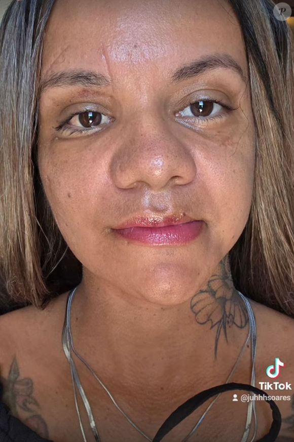 Juliana Soares mostrou o antes e depois de seu rosto após a cirurgia reparadora