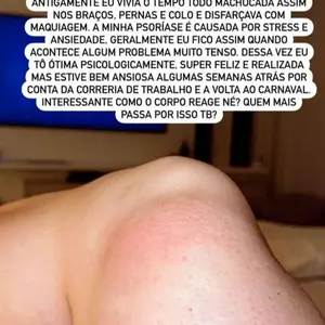 Juju Salimeni já compartilhou crises de psoríase com o público