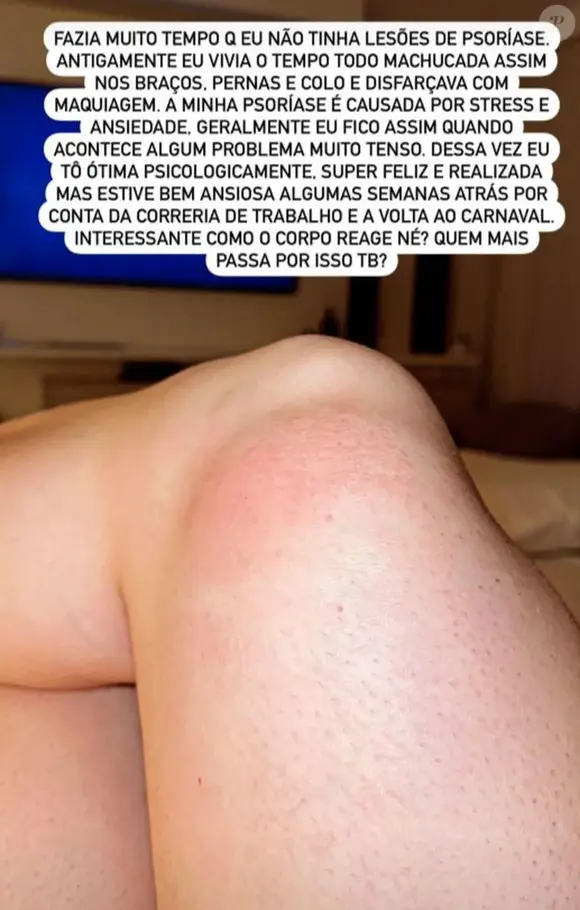 Juju Salimeni já compartilhou crises de psoríase com o público