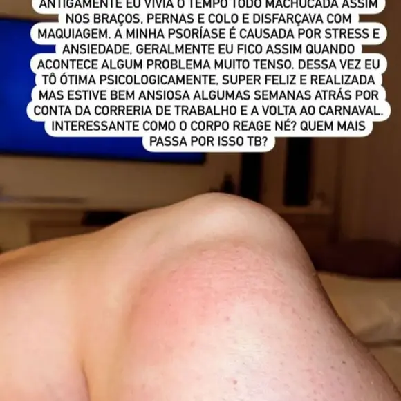 Juju Salimeni já compartilhou crises de psoríase com o público