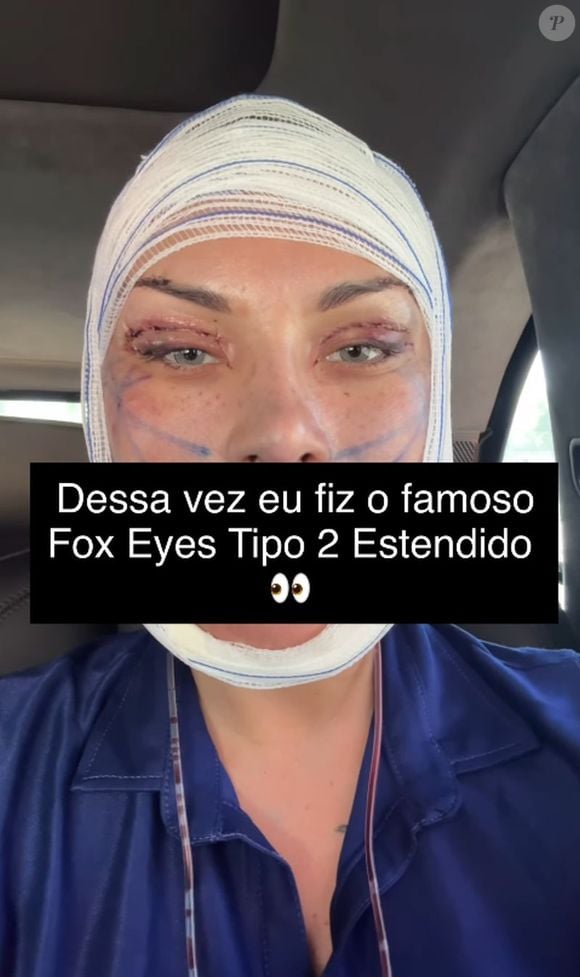 Andressa Urach fez um procedimento para deixar os olhos puxados