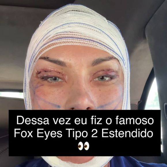 Andressa Urach fez um procedimento para deixar os olhos puxados