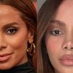 Lifting endoscópio e lifting labial: cirurgião plástico lista 4 indícios de que Anitta passou pelos 2 procedimentos estéticos