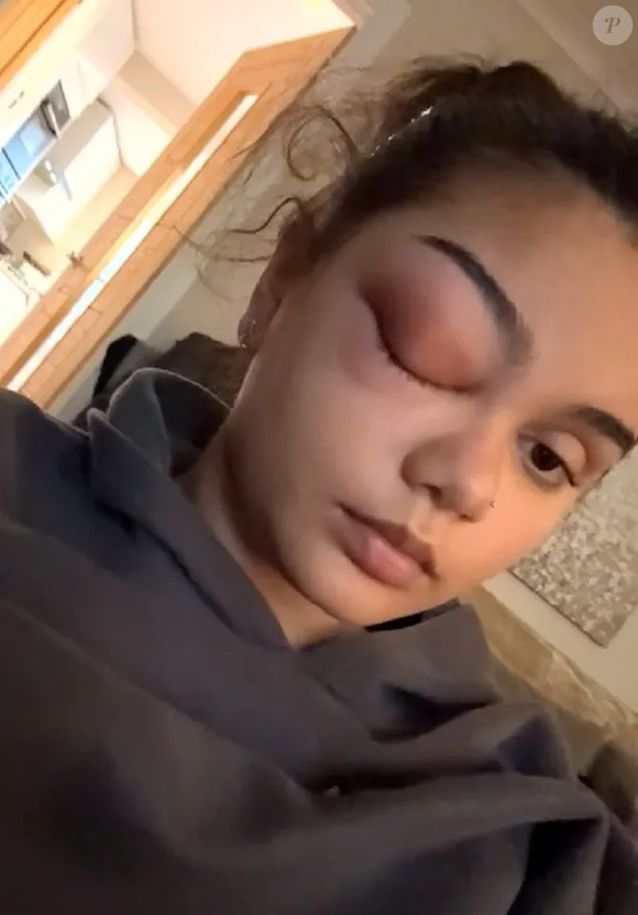 Horas após chegar ao Royal London Hospital, a adolescente recebeu a notícia de que precisaria passar por uma neurocirurgia urgente. “Disseram que precisariam raspar minha linha do cabelo e que eu precisaria passar por uma grande neurocirurgia”, contou.