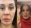 Antes e depois do rosto de Claudia Raia foi revelado pela atriz após os procedimentos estéticos com fios de colágeno