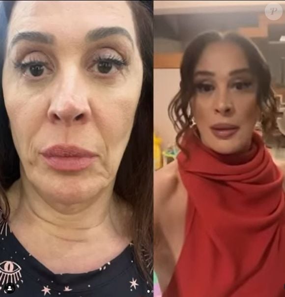 Antes e depois do rosto de Claudia Raia foi revelado pela atriz após os procedimentos estéticos com fios de colágeno