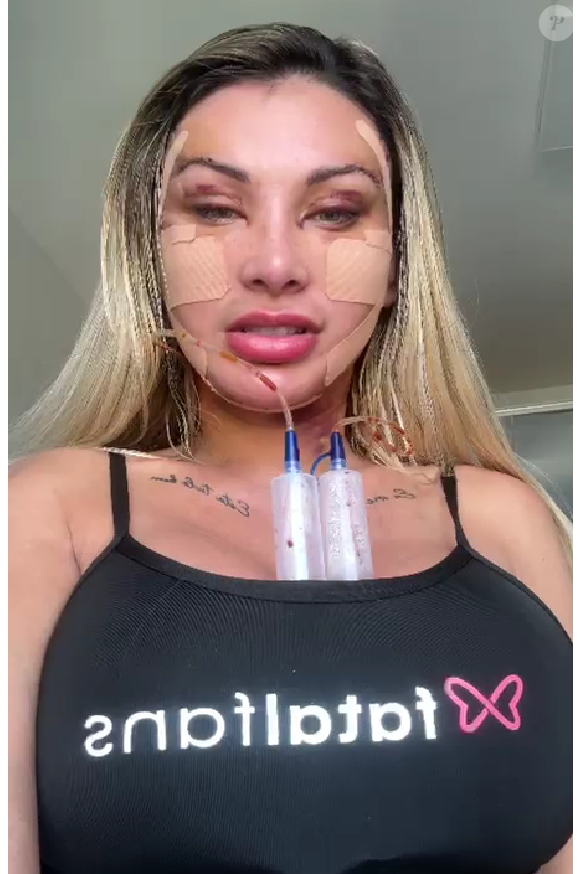 Andressa Urach mostrou seu processo de recuperação. Usando drenos, influenciadora chocou com o inchaço no rosto