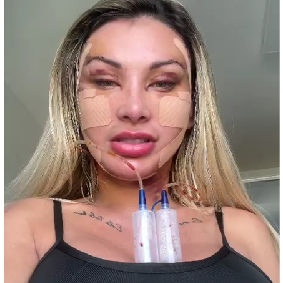 Andressa Urach mostrou seu processo de recuperação. Usando drenos, influenciadora chocou com o inchaço no rosto