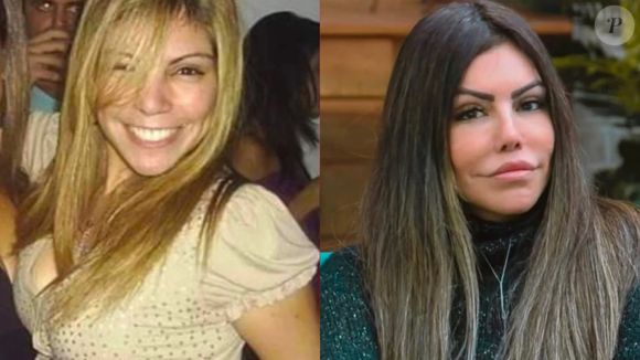 Antes e depois de Liziane Gutierrez: ex-participante de 'A Fazenda' passou por uma cirurgia malsucedida que impactou seu rosto