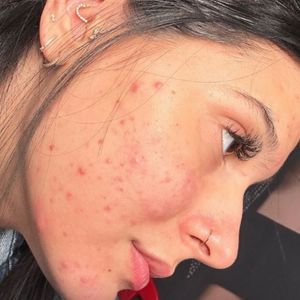 Médica faz alerta após Ana Castela revelar uso do Roacutan: "Não é qualquer caso"