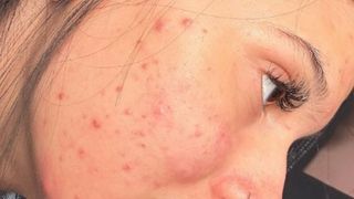 Médica faz alerta após Ana Castela revelar uso do Roacutan; saiba os potenciais efeitos colaterais e restrições de uso