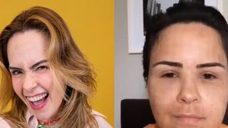 Gente? Ana Paula Renault surge irreconhecível e inchada em vídeo antigo após procedimento estético; antes e depois viraliza: 'Pelo visto funcionou'