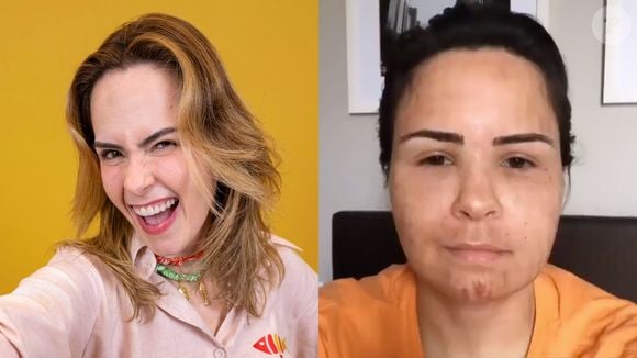 Ana Paula Renault surge irreconhecível e inchada em vídeo antigo após procedimento estético; antes e depois viraliza: 'Pelo visto funcionou'