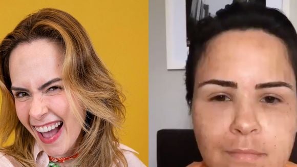 Gente? Ana Paula Renault surge irreconhecível e inchada em vídeo antigo após procedimento estético; antes e depois viraliza: 'Pelo visto funcionou'