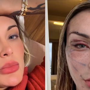Antes e depois de Andressa Urach: assim está a influenciadora no resultado parcial de seu lifting facial