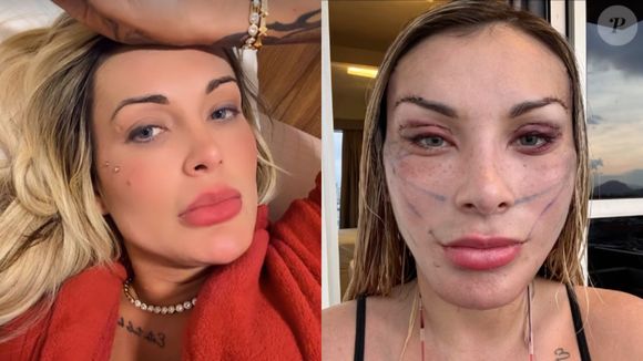 Antes e depois de Andressa Urach: assim está a influenciadora no resultado parcial de seu lifting facial