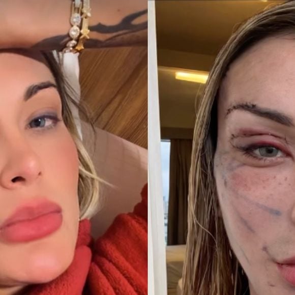Antes e depois de Andressa Urach: assim está a influenciadora no resultado parcial de seu lifting facial