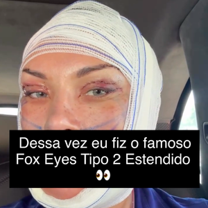 Andressa Urach revelou ter feito um Fox Eyes Tipo 2 Estendido, combinado com uma blefaroplastia