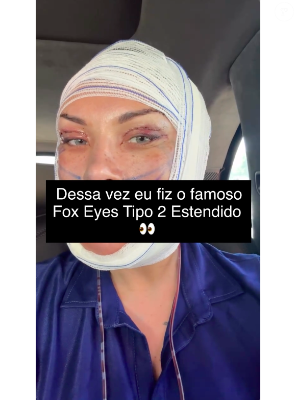 Andressa Urach revelou ter feito um Fox Eyes Tipo 2 Estendido, combinado com uma blefaroplastia