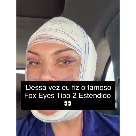 Andressa Urach revelou ter feito um Fox Eyes Tipo 2 Estendido, combinado com uma blefaroplastia