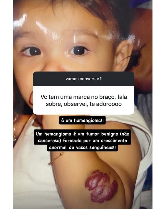 Ex-namorada de Benício Huck, Duda Guerra revelou tumor no braço e esclareceu: 'Um hemangioma é um tumor benigno (não canceroso) formado por um crescimento anormal de vasos sanguíneos'
