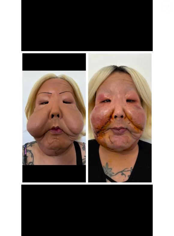 Em suas redes sociais, o Dr. Thiago Marra mostrou o resultado do procedimento e comparou o antes e depois de Juju do Pix