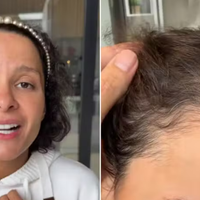'Não conseguia olhar no espelho': Maiara, dupla de Maraisa, posta vídeo com emocionante desabafo sobre sua alopecia androgenética