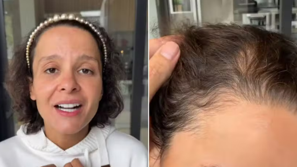 'Não conseguia olhar no espelho': Maiara, dupla de Maraisa, posta vídeo com emocionante desabafo sobre sua alopecia androgenética