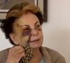 Odete Roitman no original da novela 'Vale Tudo', Beatriz Segall sofreu uma grave queda em julho de 2013 ao tropeçar e cair com o rosto no chão em rua do Rio de Janeiro