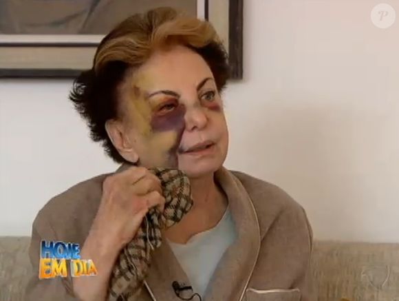 Odete Roitman no original da novela 'Vale Tudo', Beatriz Segall sofreu uma grave queda em julho de 2013 ao tropeçar e cair com o rosto no chão em rua do Rio de Janeiro