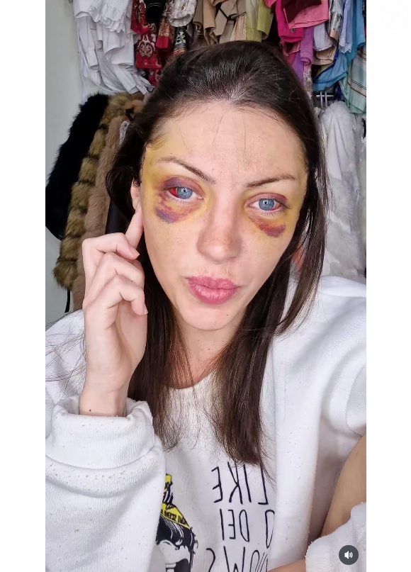 Bárbara Jankavski mostrou cada detalhe de seu lifting nas redes sociais