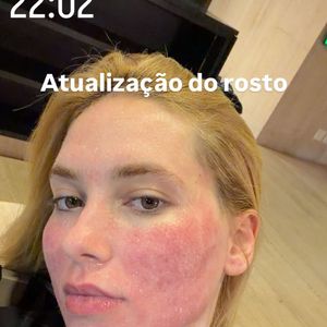 Virgínia está com o rosto vermelho e levemente inchado, o que é comum para pacientes que passam pelo procedimento