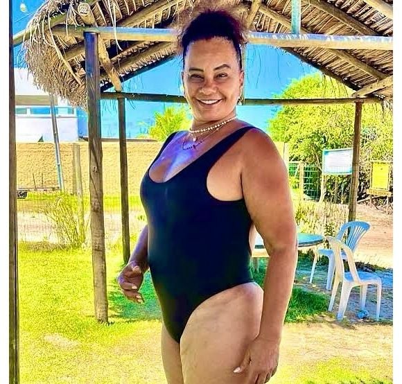 Procedimentos como os de Solange Couto têm riscos para a saúde: "Os riscos de cirurgias combinadas são maiores para perda sanguínea, trombose, infecção, seroma e sobrecarga do organismo, especialmente se os limites técnicos não forem respeitados", diz o médico